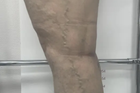 Лечение варикоза методом склеротерапии - результат после первой процедуры