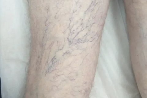 Лечение варикоза у мужчины - результат после курса склеротерапии