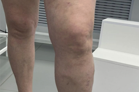 Лечение варикоза методом ЭВЛК